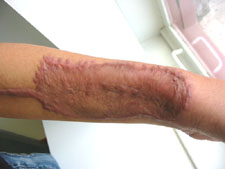 arm