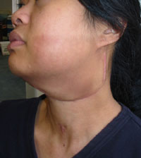 Tracheotomy hole