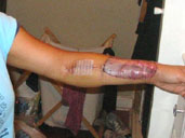 skin graft , artery, and vein extraction from arm