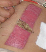 Leg wound healing nicely,... really.