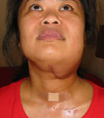 neck scar (front)