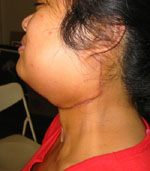 skin graft , artery, and vein extraction from arm