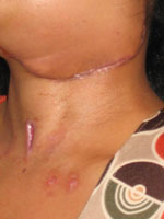 Left side of neck