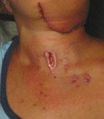 Tracheotomy hole and lymph node extraction scar