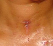Tracheotomy hole