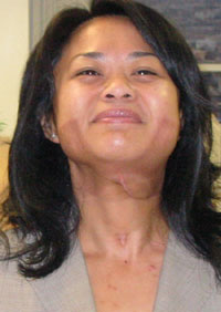 radiation therapy
